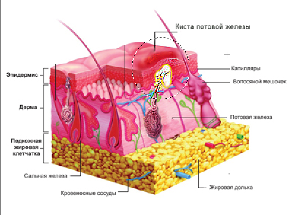 формирование ретенционных, в том числе и железистых кист